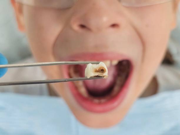 Best Chipped Tooth Repair Near Me  in Pulaski, NY